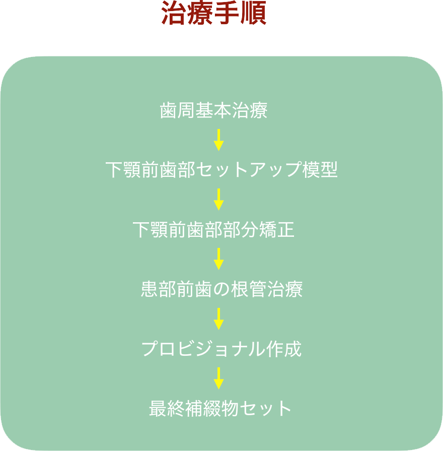 歯周基本治療→下あご前歯部セットアップ模型→下顎前歯部部分矯正→幹部前歯の根管治療→プロビジョナル作成→最終補物セット